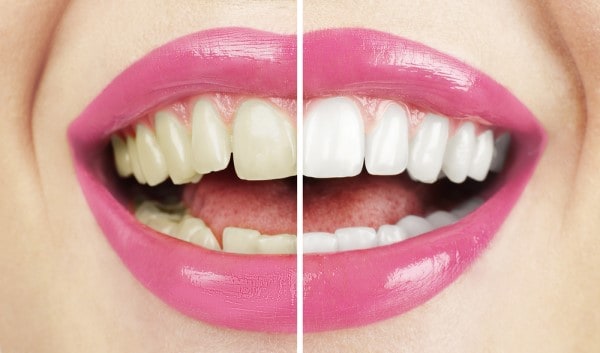 What Makes Ultima White Teeth Whitening Different Stevenage