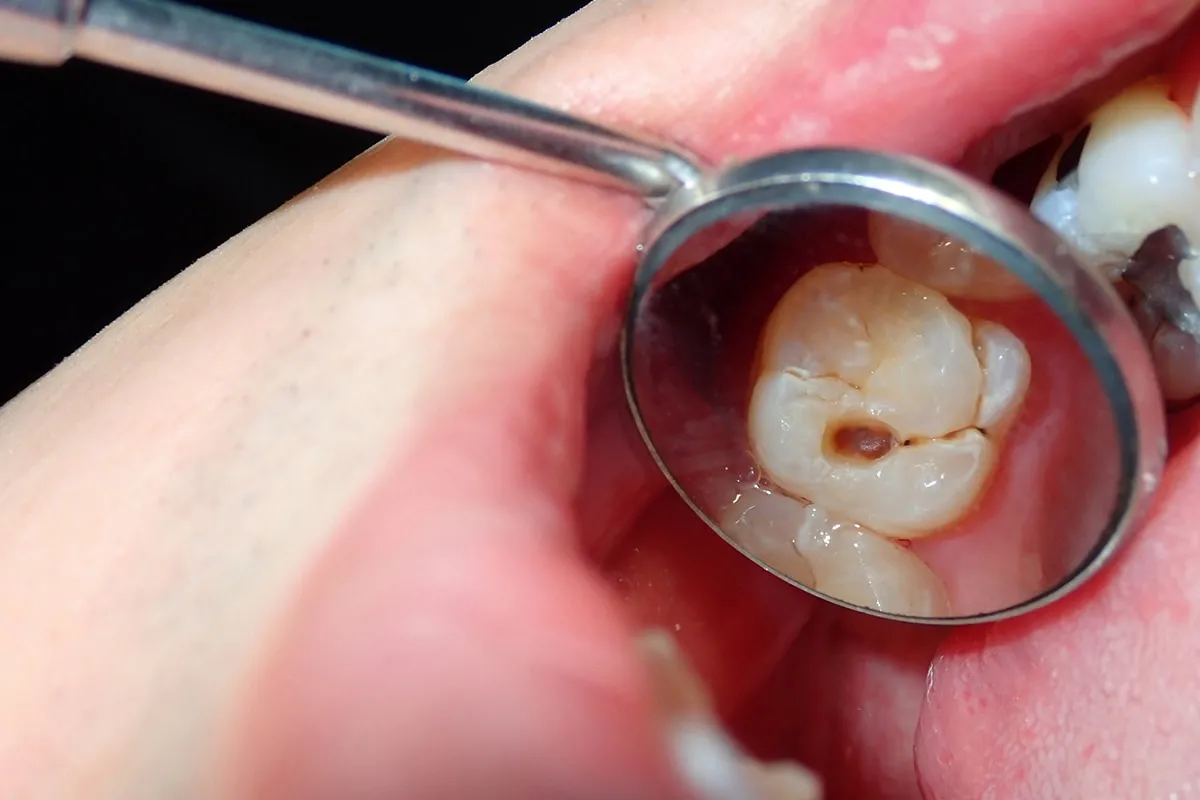 Why Do Teeth Crack? Common Causes to Know Stevenage