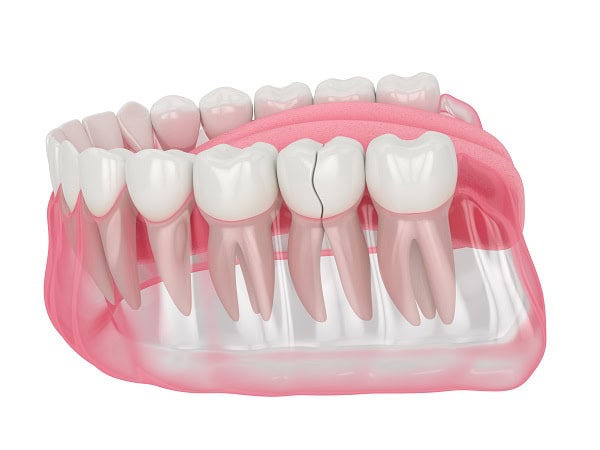How Can You Manage Pain and Discomfort After a Root Canal Stevenage?