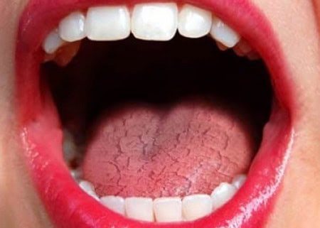 Dry Mouth and Its Role in Tooth Decay Stevenage