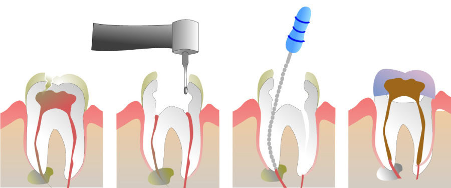 How Do You Properly Care for Your Teeth After a Root Canal Stevenage