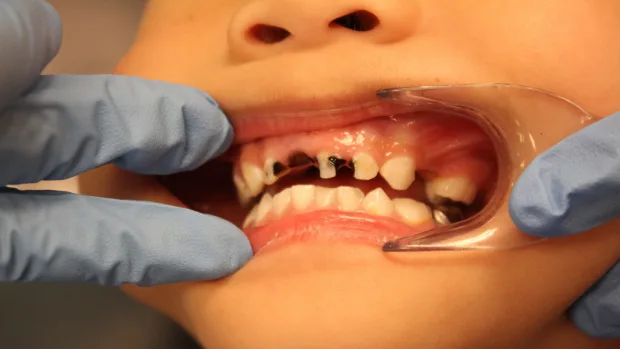 Which Foods and Drinks Cause the Most Damage to Young Smiles Stevenage?