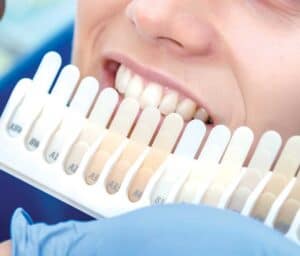 Ultimate Guide to Teeth Whitening with Natural Ingredients Stevenage