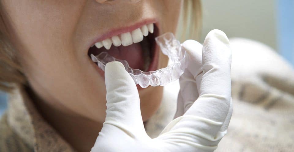 Why Bleaching Trays Require More Time Stevenage